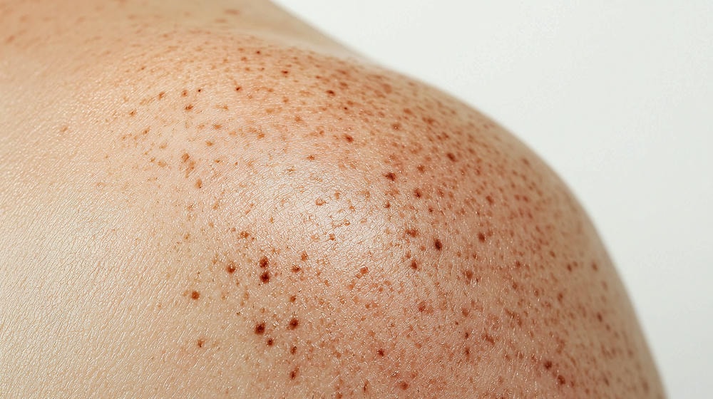 da nổi đốm nâu không ngứa. Cận cảnh da cho thấy kết cấu không đồng đều và các đốm đen trên vai