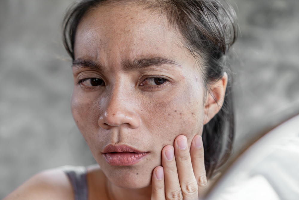 da sạm nám. Cận cảnh người phụ nữ nhìn ra xa