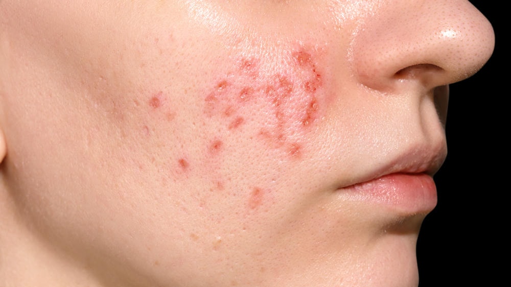 Qua dấu hiệu trên hình, chúng ta có thể nhận biết các triệu chứng của nhiễm trùng da, đồng thời nhấn mạnh tầm quan trọng của phòng ngừa nhiễm trùng da trong thực hành lâm sàng.
