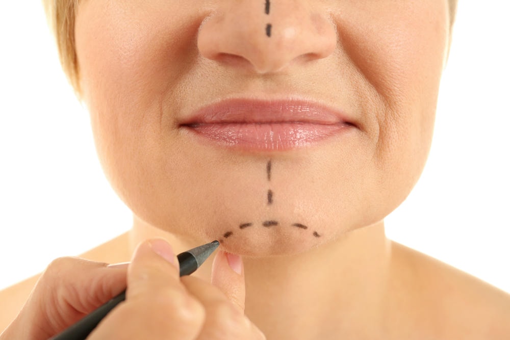 Trong quy trình độn cằm tiên tiến của Lona Skin Lab, chuyên gia da liễu chuyên sử dụng kỹ thuật phẫu thuật thẩm mỹ để độn cằm và độn cằm, đảm bảo tính tự nhiên và thẩm mỹ cao cho khuôn mặt.