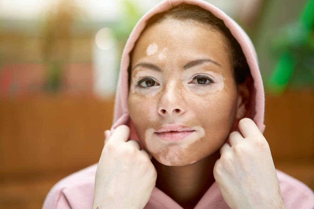 Phương pháp giảm sắc tố da tiên tiến với chăm sóc da kỹ lưỡng tại Lona Skin Lab được các chuyên gia da liễu khuyến cáo kết hợp cùng tẩy da chết cho da để đạt kết quả điều trị tối ưu.