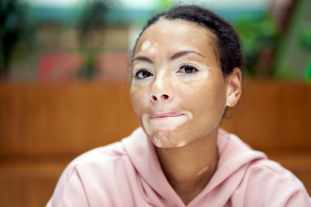 Hình ảnh minh họa quá trình giảm sắc tố da này tại Lona Skin Lab, nơi các chuyên gia da liễu cung cấp dịch vụ chăm sóc da chuyên nghiệp và tẩy da chết cho da hiệu quả nhằm khôi phục sắc tố tự nhiên.