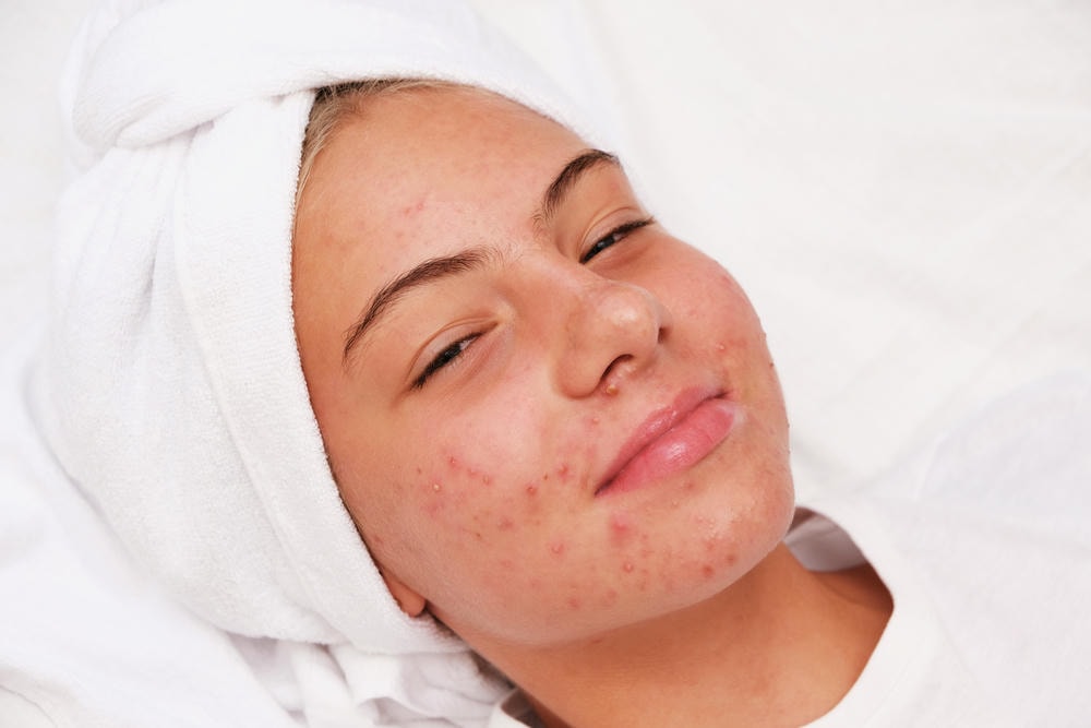 Sự kết hợp của sữa rửa mặt cho da mụn và sữa rửa mặt da dầu mụn với liệu pháp trị thâm mụn được áp dụng trong chăm sóc da dầu mụn, đảm bảo mang lại trị thâm mụn hiệu quả cho làn da.