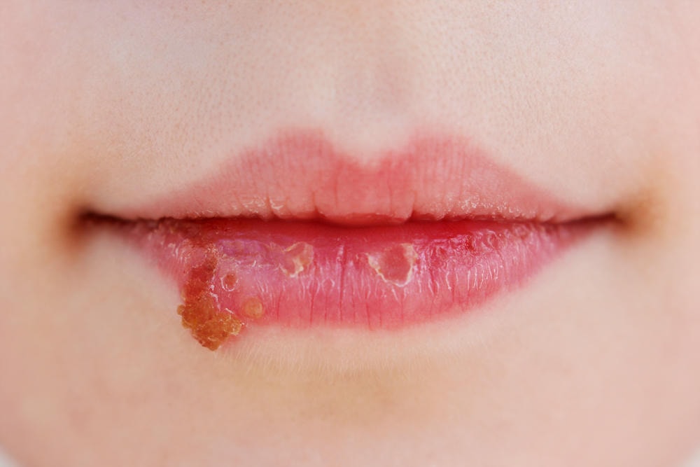 Qua hình ảnh, chuyên gia da liễu chỉ ra rằng herpes là bệnh gì với biểu hiện triệu chứng herpes đặc trưng, đồng thời đưa ra các chế độ điều trị herpes hợp lý giúp kiểm soát bệnh herpes.