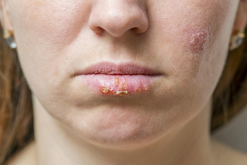 Hình ảnh này phản ánh herpes là bệnh gì qua dấu hiệu viêm loét ở môi, kết hợp lời khuyên của chuyên gia da liễu về cách nhận diện triệu chứng herpes và cách điều trị herpes hiệu quả cho bệnh herpes.