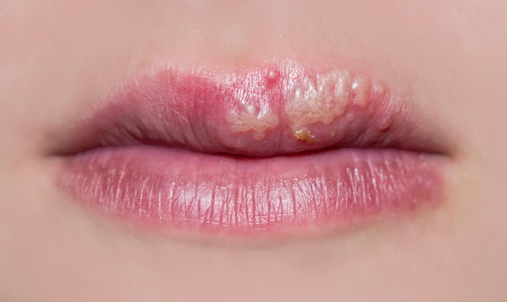 herpes là gì. Biểu hiện của herpes trên môi các cô gái