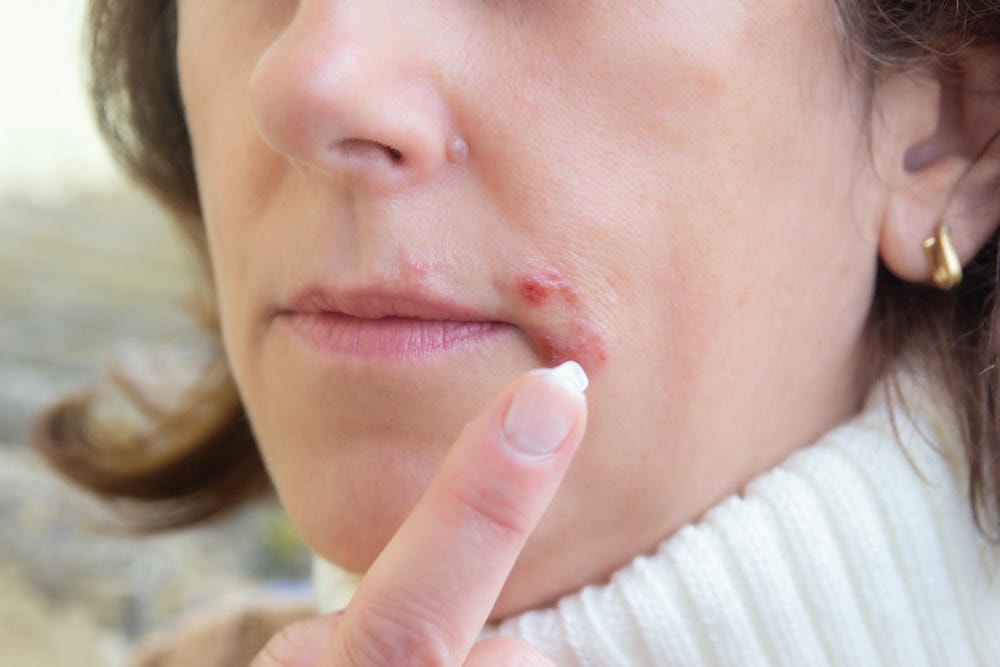 Hình minh họa herpes là gì thể hiện triệu chứng Herpes đặc trưng, theo nhận định của chuyên gia da liễu thẩm mỹ Lona, hỗ trợ điều trị Herpes và hướng tới chiến lược phòng ngừa Herpes hiệu quả.