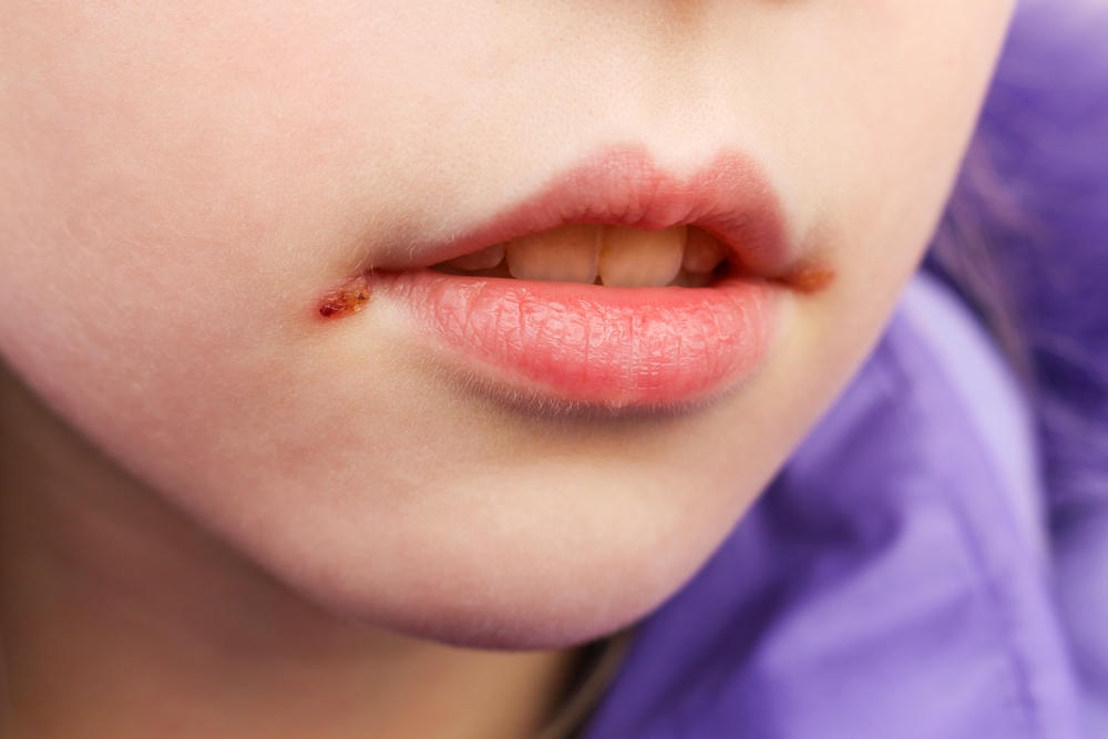 Ảnh minh họa herpes trên môi với sự tư vấn của chuyên gia da liễu, giải thích herpes là bệnh gì và nhấn mạnh các triệu chứng herpes, từ đó đưa ra hướng điều trị herpes cho bệnh herpes.