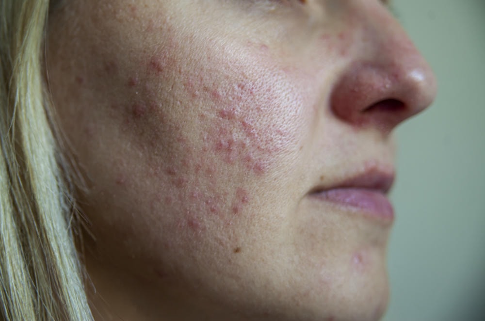 hình ảnh mụn trứng cá. Một cô gái trẻ có làn da có vấn đề Ảnh trước và sau khi điều trị mụn trứng cá và Demodecosis Điều trị da Liệu pháp spa Chăm sóc da chuyên nghiệp và thẩm mỹ