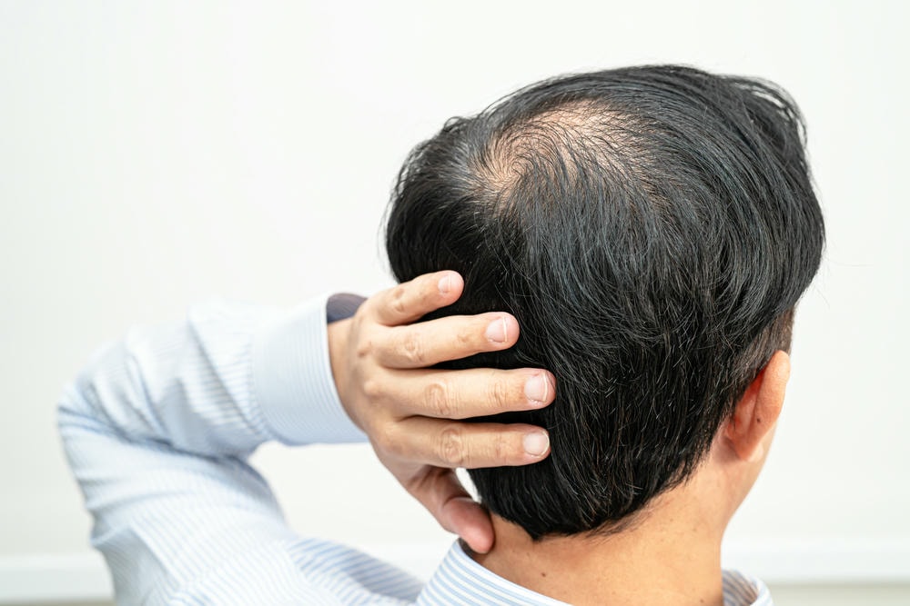 hói tóc. Hói ở giữa đầu và bắt đầu không rụng tóc bóng của người đàn ông văn phòng thông minh năng động kinh doanh châu Á trưởng thành