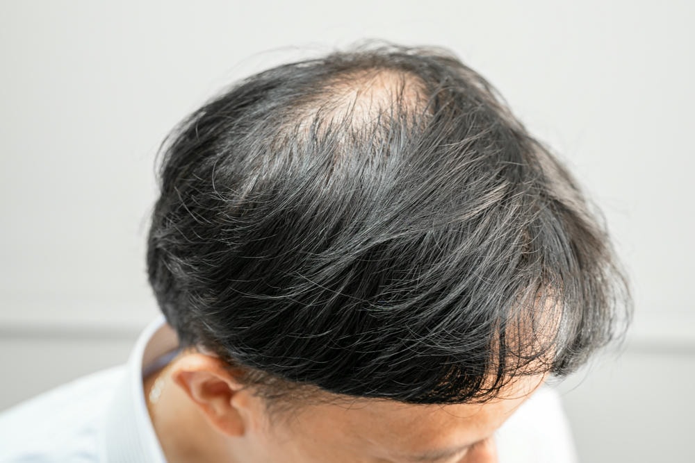 hói tóc. Hói ở giữa đầu và bắt đầu không rụng tóc bóng của người đàn ông văn phòng thông minh năng động kinh doanh châu Á trưởng thành