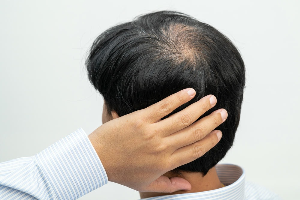 hói tóc. Hói ở giữa đầu và bắt đầu không rụng tóc của người trưởng thành