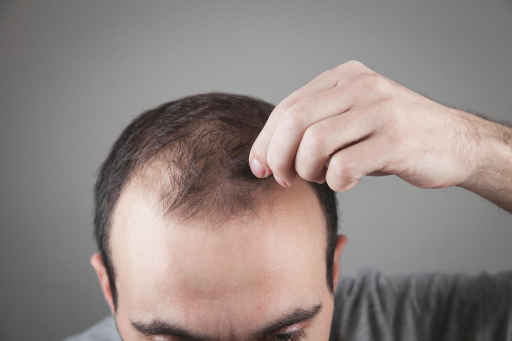 hói. Người đàn ông da trắng kiểm tra tóc của mình. Vấn đề rụng tóc