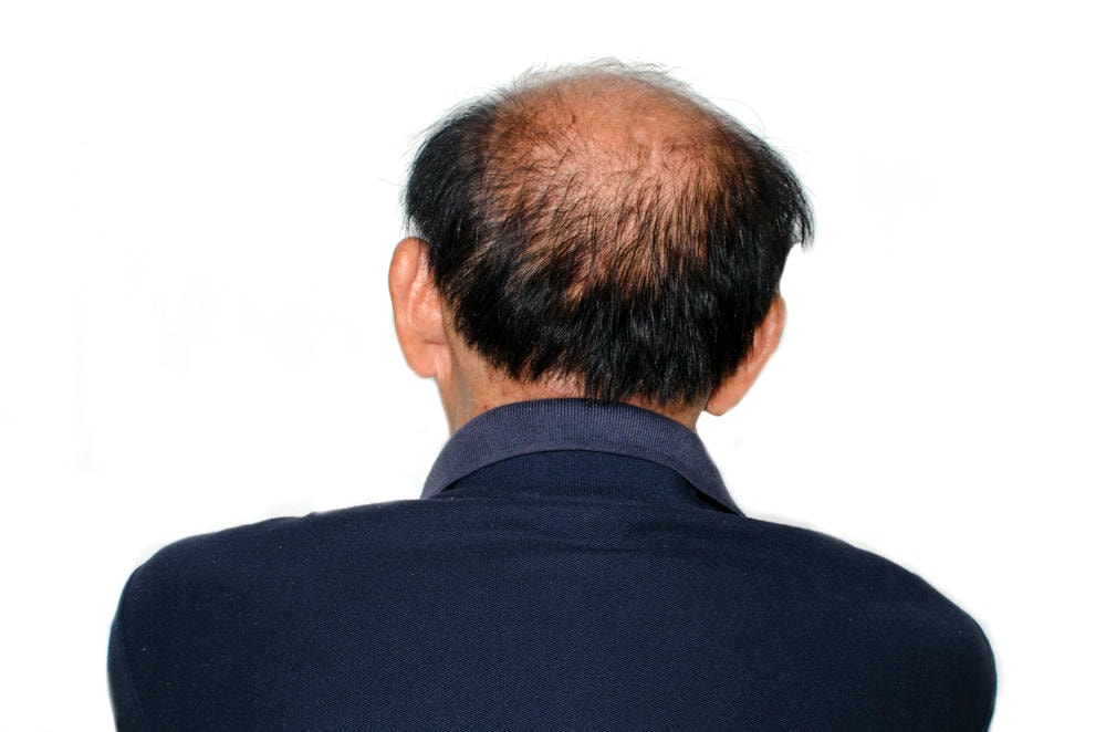 hói. Nhìn từ phía sau người đàn ông bị hói trên nền trắng
