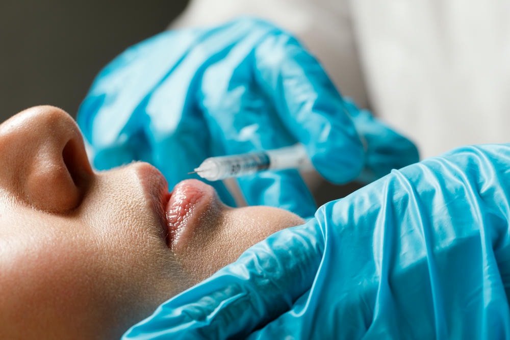 Ảnh chụp quy trình tiêm Filler Juvederm do chuyên gia da liễu thẩm mỹ triển khai với các loại filler Juvederm đa dạng, khẳng định filler juvederm có mấy loại an toàn filler Juvederm và hiệu quả filler Juvederm vượt trội.
