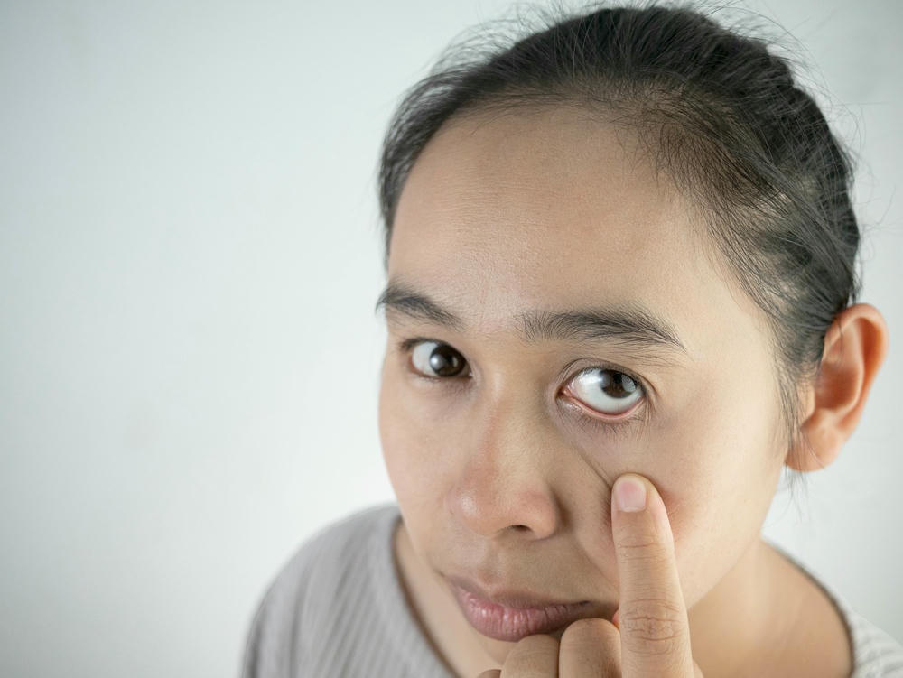 mắt thâm. Ảnh chân dung cận cảnh của một cô gái trẻ trên nền trắng