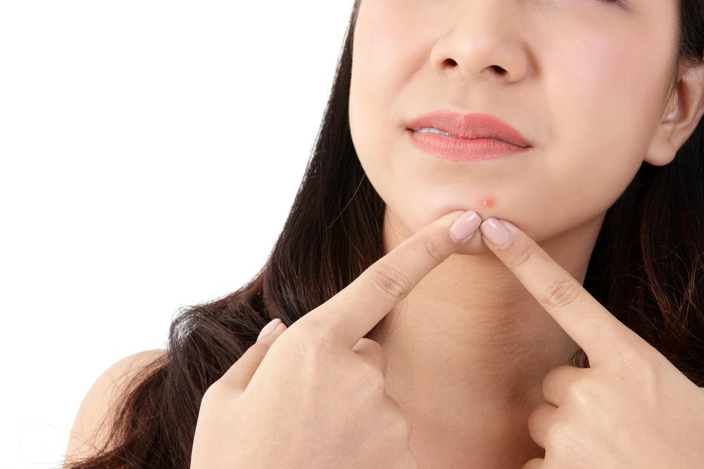 Hình ảnh này cho thấy mụn dưới cằm rõ ràng, từ đó giúp chuyên gia xác định nguyên nhân mụn dưới cằm và triển khai cách trị mụn dưới cằm toàn diện, bao gồm việc nhận diện mụn trứng cá ở cằm và mụn ẩn dưới cằm qua những dấu hiệu lâm sàng.