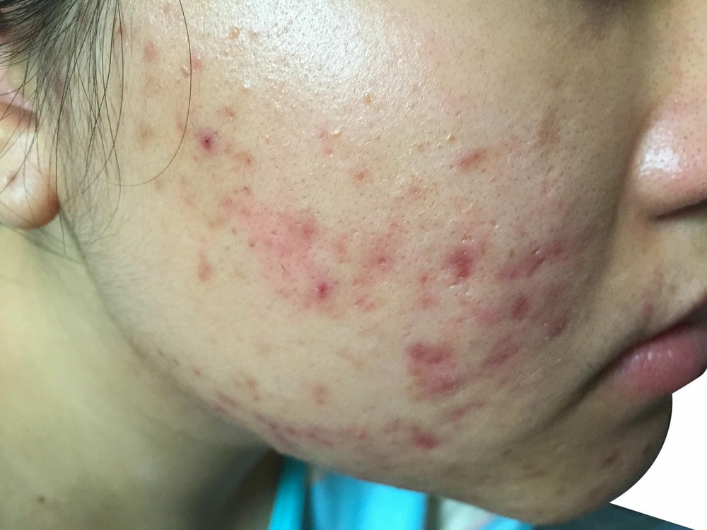 Việc phát hiện sớm mụn mạch lươn trên da đòi hỏi điều trị mụn mạch lươn chặt chẽ, kết hợp nghiên cứu nguyên nhân mụn mạch lươn và thực hiện lối sống lành mạnh nhằm phòng ngừa mụn mạch lươn hiệu quả.