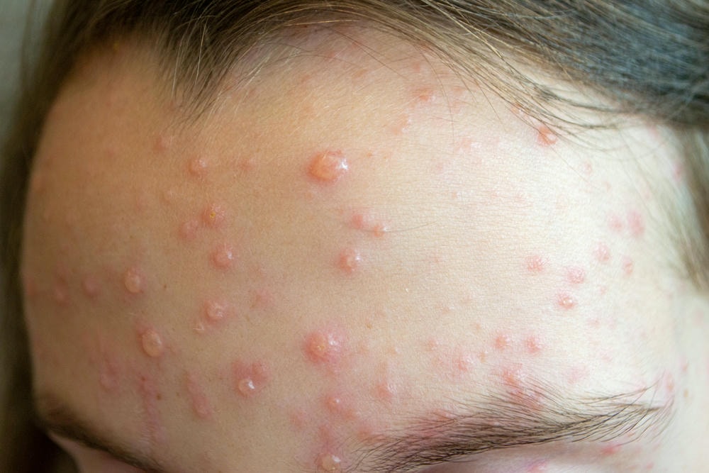 Trong buổi khám chuyên sâu, chuyên gia da liễu của Phòng Khám Lona Skin Lab khuyến cáo rằng mụn nước cần được xử lý bằng cách điều trị mụn nước hiệu quả thông qua phương pháp trị mụn nước hiện đại và chăm sóc da mụn nước sát sao.