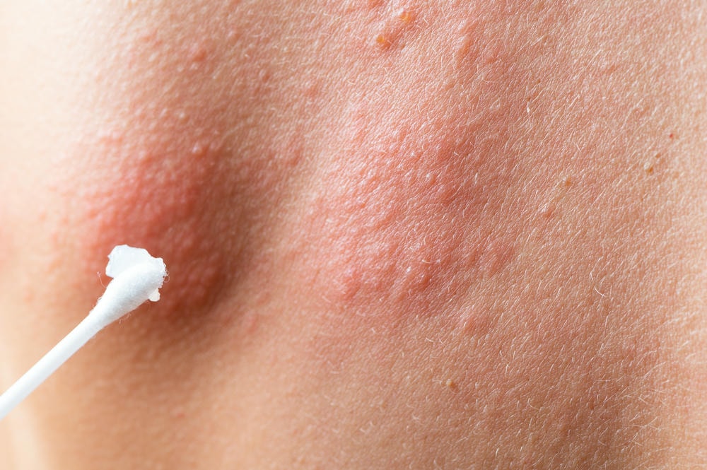 Với kinh nghiệm lâm sàng chuyên sâu, chuyên gia da liễu tại Phòng Khám Lona Skin Lab đã chứng minh rằng mụn nước có thể được khắc phục thông qua cách điều trị mụn nước hiệu quả khi áp dụng phương pháp trị mụn nước cụ thể và chăm sóc da mụn nước định kỳ.