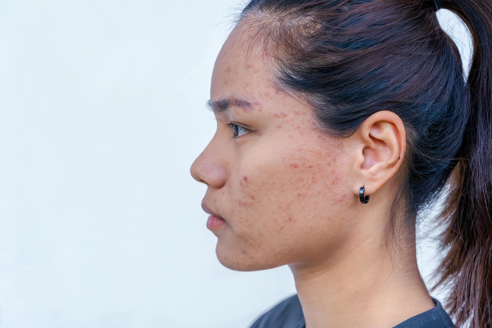 mụn trứng cá nhẹ. Cận cảnh người phụ nữ châu Á trẻ tuổi lo lắng về khuôn mặt của mình khi cô ấy gặp vấn đề với làn da trên khuôn mặt