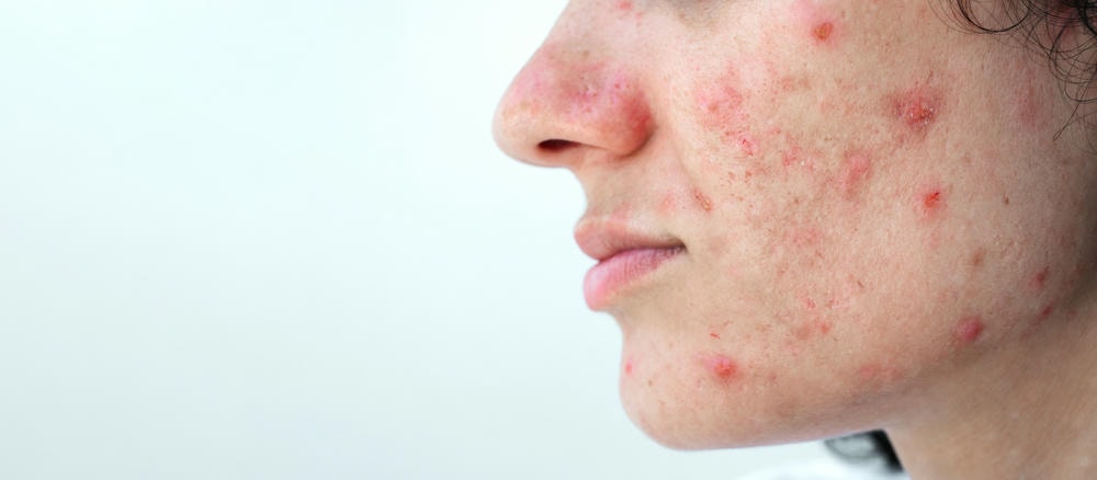 mụn viêm. khuôn mặt phụ nữ của người phụ nữ trẻ có mụn và mụn nhọt trên da có vấn đề cận cảnh trên nền trắng cô lập