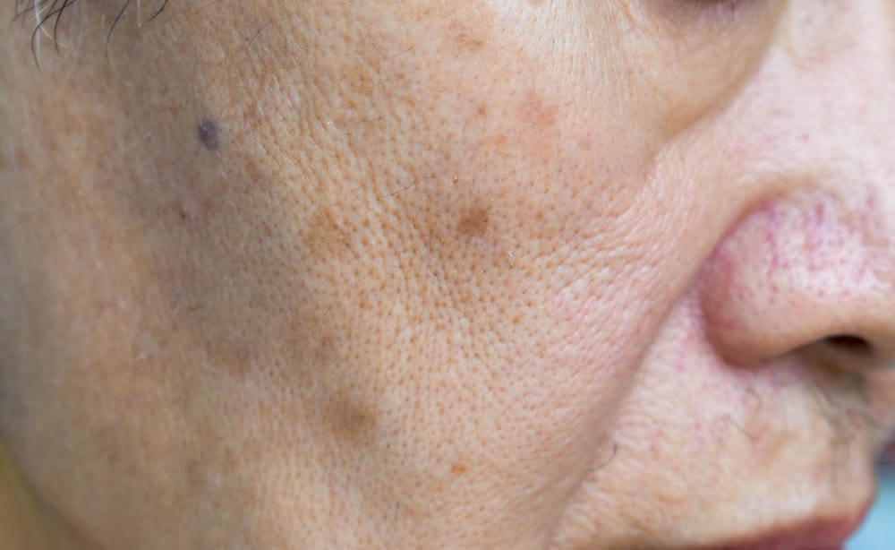 lỗ chân lông to trên mặt người lớn tuổi châu Á với nếp gấp da