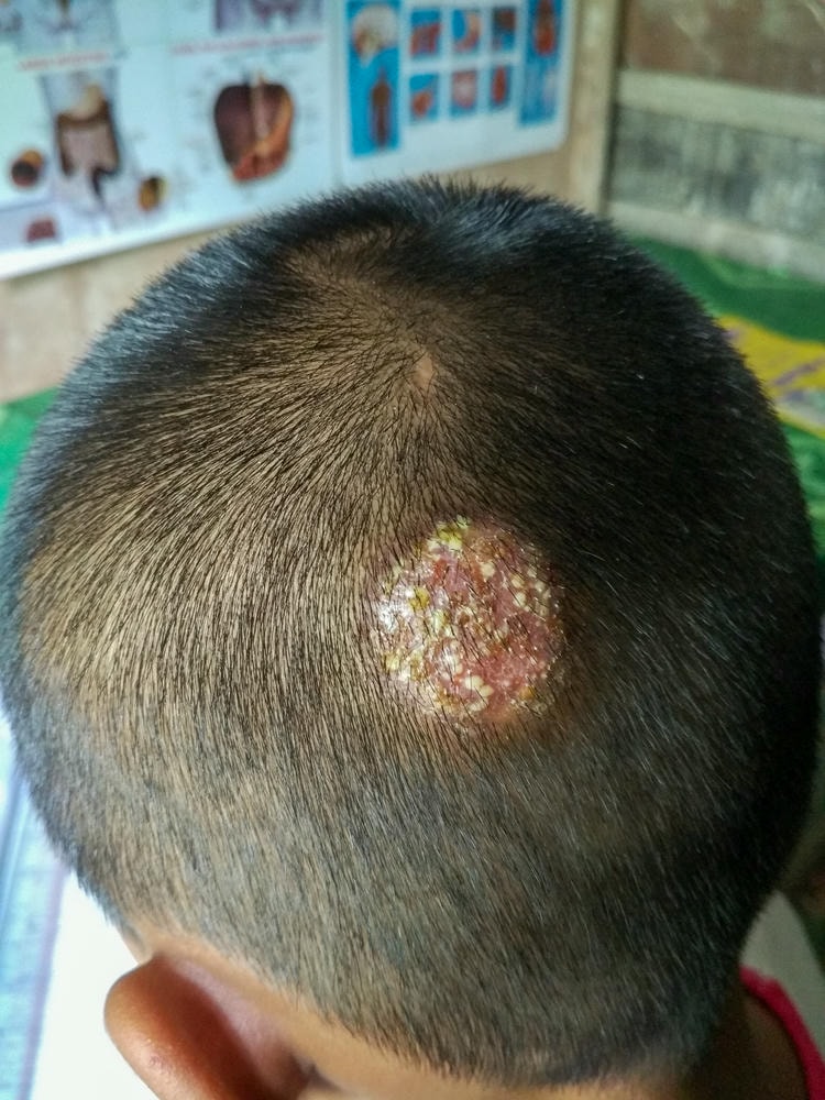 Hình ảnh bệnh nhân với da đầu bị nấm là minh chứng cho việc hiểu nguyên nhân da đầu bị nấm và áp dụng điều trị nấm da đầu kịp thời theo phương pháp của chuyên gia da liễu Lona, đi kèm với hướng dẫn trị nấm da đầu cụ thể.