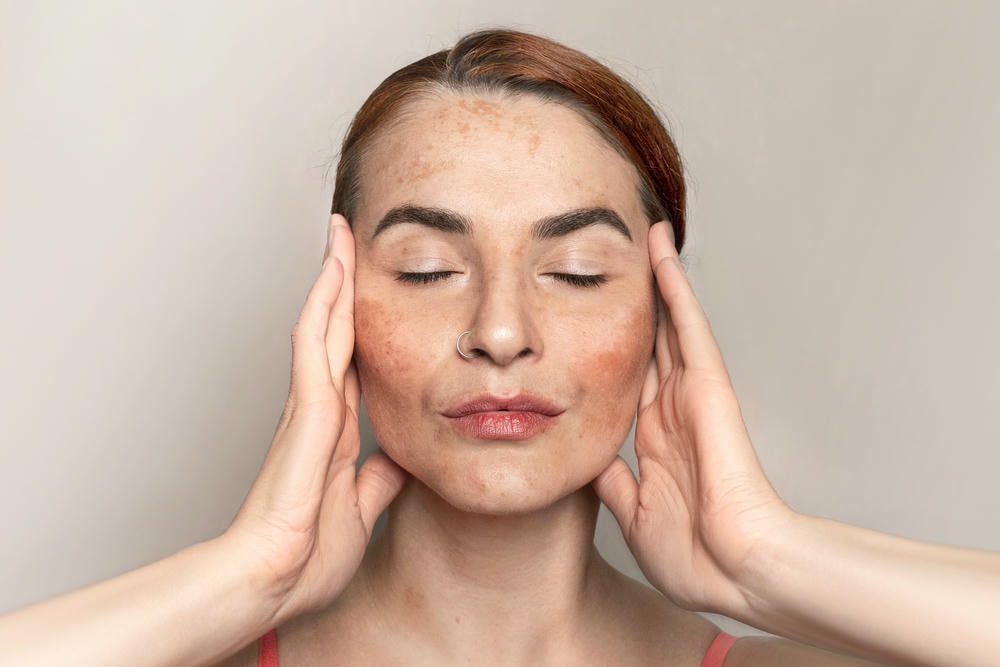Hình ảnh mô tả rõ nét nám hori ở mức độ sâu, được các chuyên gia da liễu của Lona Skin Lab áp dụng điều trị nám cùng giải pháp điều trị nám hiện đại nhằm quản lý và cải thiện tình trạng nám hori.