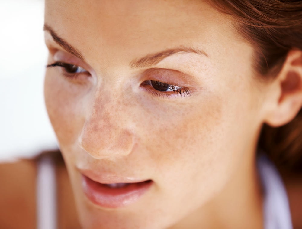 Khi đối mặt với nám hori như trong hình ảnh, Lona Skin Lab và chuyên gia da liễu khẳng định rằng điều trị nám bằng giải pháp điều trị nám tiên tiến là chiến lược tối ưu để kiểm soát tình trạng nám hori.