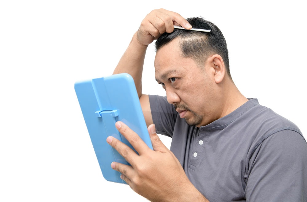 Qua hình ảnh, chuyên gia da liễu nhấn mạnh sự cần thiết của việc chẩn đoán nguyên nhân hói tóc chính xác và khuyến nghị điều trị hói tóc tích cực, giúp hạn chế tình trạng rụng tóc và phòng ngừa hói tóc tái phát.