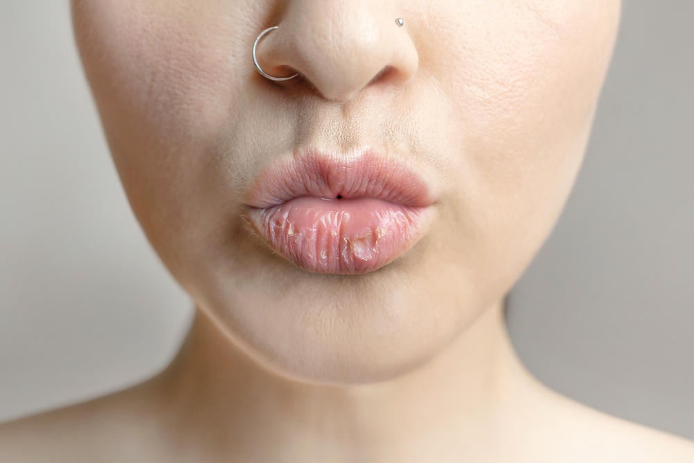 nứt môi. Người phụ nữ cho thấy đôi môi khô nứt nẻ vấn đề về da khô với bệnh miệng đóng lại Nụ hôn môi khô