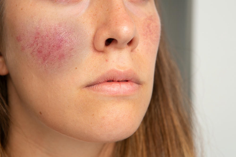 Trong bức ảnh, tình trạng da bị rosacea là gì được nhận diện qua các dấu hiệu đỏ, phù hợp với các tiêu chí chuẩn của rosacea là gì trong đánh giá lâm sàng.