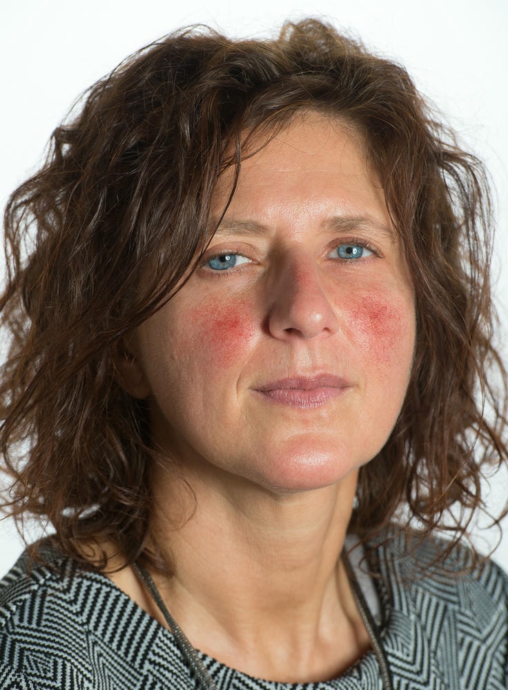 rosacea – Rosacea biểu hiện qua chứng đỏ mặt rõ ràng, cho thấy nguyên nhân Rosacea từ yếu tố viêm, các triệu chứng Rosacea như mạch máu giãn nở và điều trị Rosacea đòi hỏi sự can thiệp chuyên sâu từ bác sĩ.