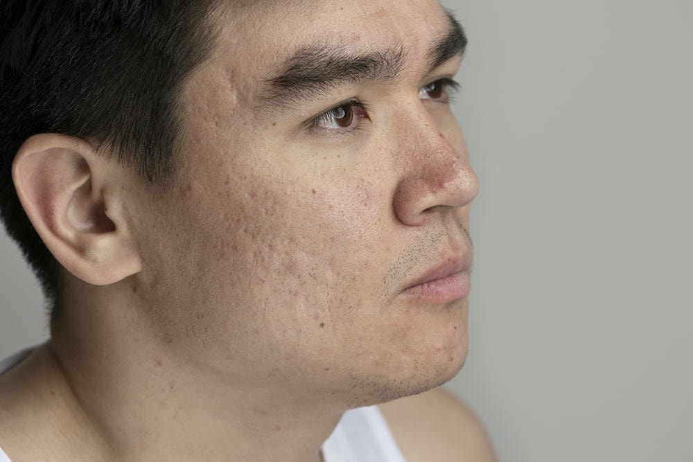 sẹo do mụn. Cận cảnh lỗ chân lông trong quá trình chăm sóc da mặt