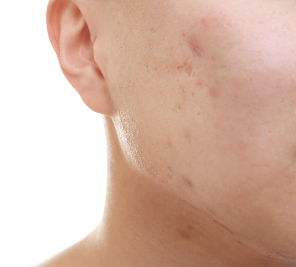 Trong bối cảnh sẹo do mụn đang trở thành mối quan tâm, các chuyên gia da liễu thẩm mỹ Lona khuyến nghị áp dụng phương pháp điều trị sẹo mụn hiệu quả nhằm cải thiện sẹo mụn trên da. 