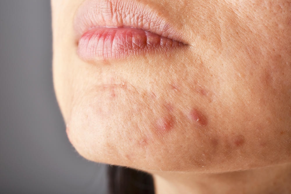 Sự kết hợp giữa công nghệ hiện đại và tay nghề chuyên môn của chuyên gia da liễu tại thẩm mỹ Lona đã chứng minh hiệu quả trong điều trị sẹo lồi và trị sẹo thâm do mụn, khi sẹo lồi do mụn được cải thiện qua các liệu trình điều trị sẹo lồi chuyên sâu.