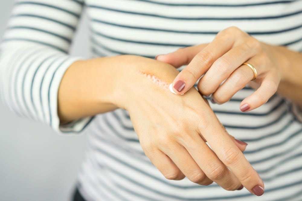 sẹo lồi. Một người phụ nữ bôi kem trị sẹo lên vết sẹo bỏng dầu ăn đã lành trên tay. Chữa lành, Loại bỏ, Điều trị bỏng dầu nóng, Vitamin E, Chăm sóc sẹo, Sản phẩm chăm sóc da, Kem y tế.