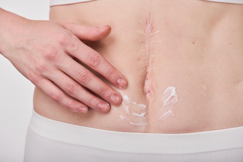 Trong quá trình trị sẹo lõm hiện đại tại Lona Skin Lab, các chuyên gia da liễu luôn áp dụng phương pháp trị sẹo lõm tiên tiến nhằm mang lại kết quả tối ưu cho bệnh nhân. 