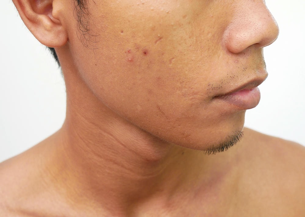Hình ảnh trình bày cận cảnh da với tình trạng sẹo mụn, thể hiện sự chuyên nghiệp trong việc chuẩn đoán và điều trị sẹo mụn, qua đó góp phần mang lại hiệu quả điều trị đột phá.