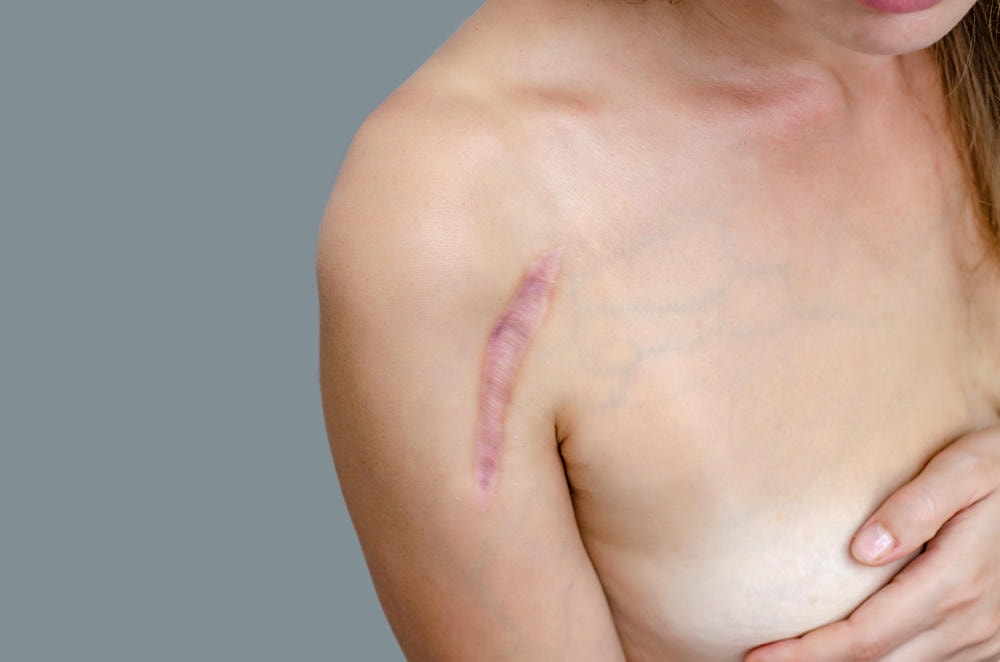 Trong bối cảnh sẹo phẫu thuật, hình ảnh minh họa quá trình điều trị sẹo đỏ hồng và sẹo màu đỏ hồng khi được can thiệp bằng các phương pháp điều trị sẹo chuyên sâu tại các phòng khám uy tín.