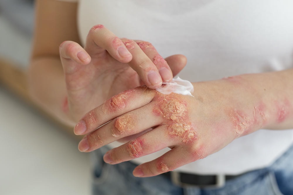 Phương pháp điều trị viêm da tiết bã đòi hỏi sự kết hợp giữa thuốc trị viêm da tiết bã theo chỉ định và các mẹo dân gian trị viêm da tiết bã, đảm bảo hiệu quả trong việc kiểm soát viêm da tiết bã ở mặt.