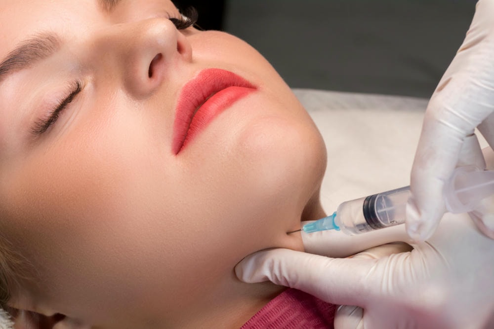 Bằng kỹ thuật tiêm cằm tròn và tiêm filler cằm, chuyên gia da liễu thẩm mỹ đã tạo hình cằm tự nhiên, giúp định hình cằm V-line nổi bật.