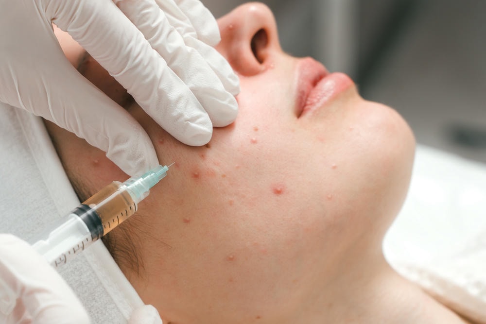 Áp dụng Mesotherapy trong điều trị mụn, phương pháp trị mụn này cung cấp giải pháp cho bệnh nhân muốn không dùng kháng sinh và xem Isotretinoin thay thế là lựa chọn tối ưu.