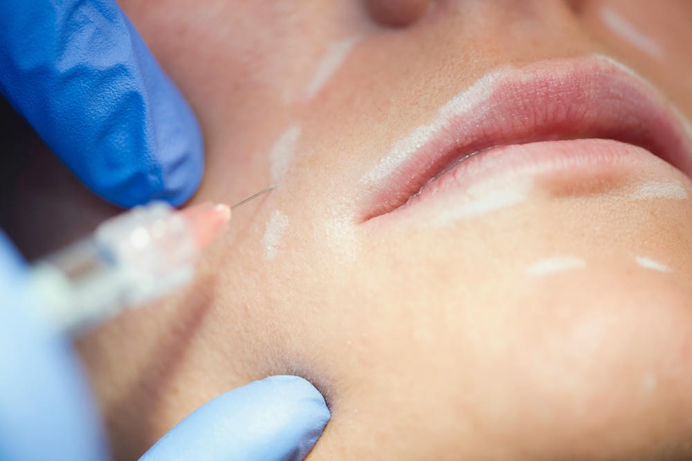 Với sự tận tâm của chuyên gia Lona Skin Lab, phương pháp xoá rãnh cười được áp dụng nhằm xoá rãnh cười hiệu quả, đồng thời khắc phục cách làm mờ rãnh cười để trẻ hoá da mặt.