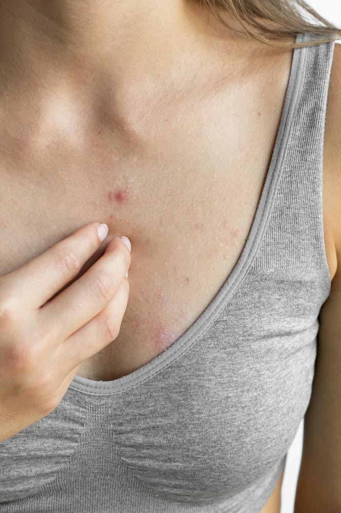 Trên cơ sở chuyên gia da liễu, trị mụn ngực và trị mụn ngực bằng cách trị mụn ngực khoa học là giải pháp trị mụn ngực hàng đầu cho mụn ngực ngày càng bền vững.