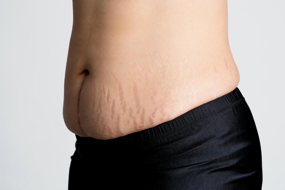 Hình minh họa này khẳng định hiệu quả trị rạn da qua việc Lona Skin Lab triển khai bí quyết điều trị rạn da theo hướng dẫn của chuyên gia da liễu, kết hợp giải pháp chăm sóc da hiện đại giúp phục hồi rạn da một cách tự nhiên. 