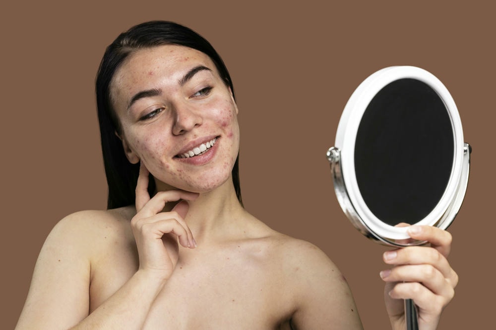 Hình ảnh mụn trứng cá tối ưu trong điều trị mụn trứng cá, qua đó thể hiện các loại mụn trứng cá khác nhau, đặc biệt là mụn đầu đen và mụn đầu trắng cần được chăm sóc cẩn thận.
