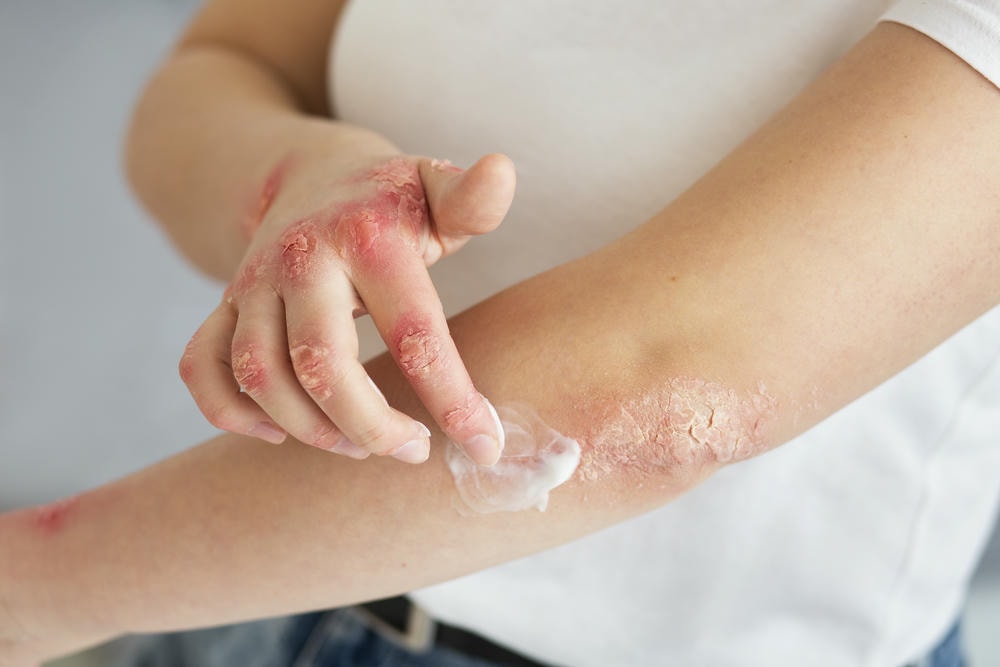 Ảnh này cho thấy một biểu hiện rõ rệt của vết chàm, trong đó các triệu chứng vết chàm được nhận diện qua sự mất đồng đều sắc tố, đây là yếu tố quan trọng trong việc xác định nguyên nhân vết chàm và đề xuất điều trị vết chàm chuyên sâu nhằm phòng ngừa vết chàm tái phát.