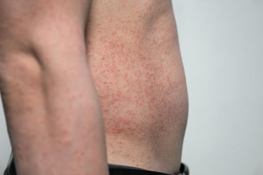 Đối với viêm da demodex, việc xác định sự hiện diện của demodex là quan trọng để chuyên gia da liễu khuyến nghị điều trị demodex an toàn, sử dụng phương pháp điều trị demodex có hiệu quả trong việc làm giảm viêm da demodex.